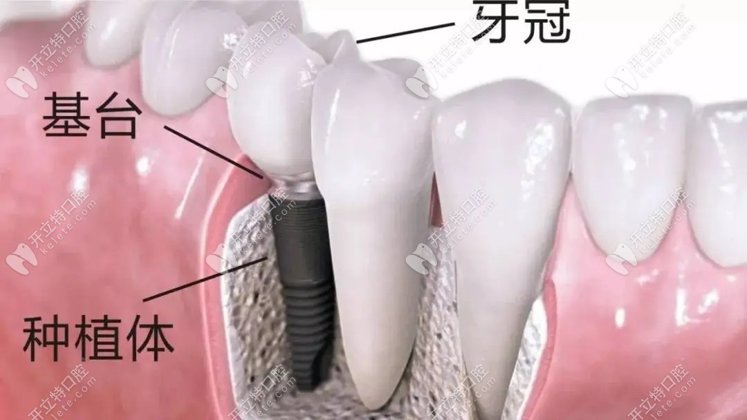 种植牙结构示意图