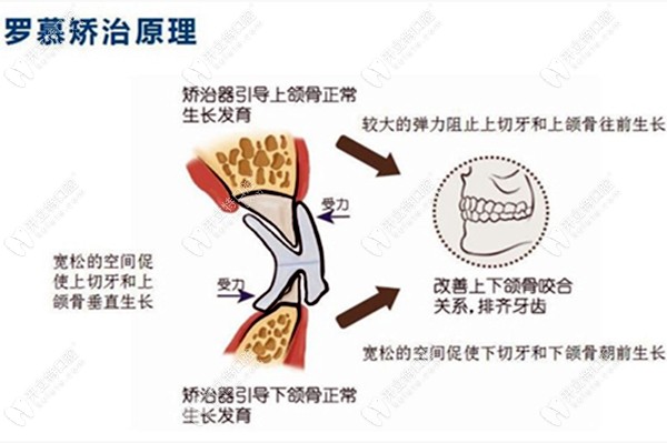 羅慕矯治的原理