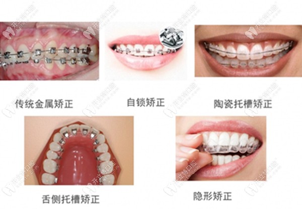 牙齿矫正的类型图