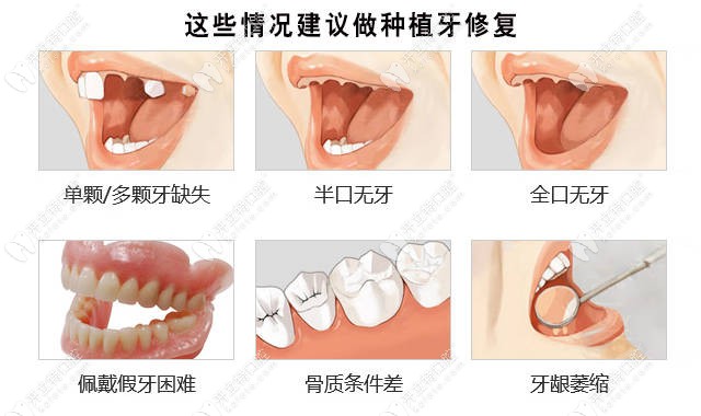 樊雄越院長(zhǎng)建議這些情況要做種植