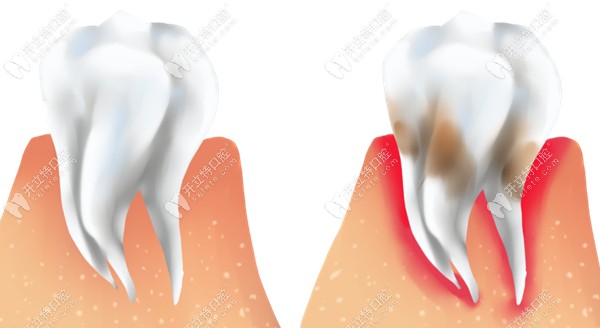 健康牙龈与发炎牙龈对比