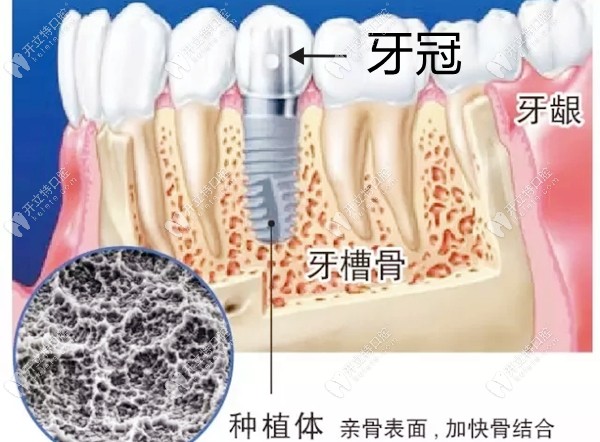 种植牙是由牙冠和种植体组成