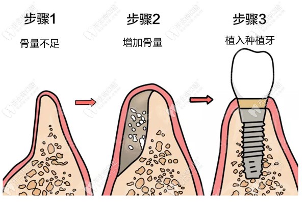 樊院長(zhǎng)可做牙槽骨骨量不足種植