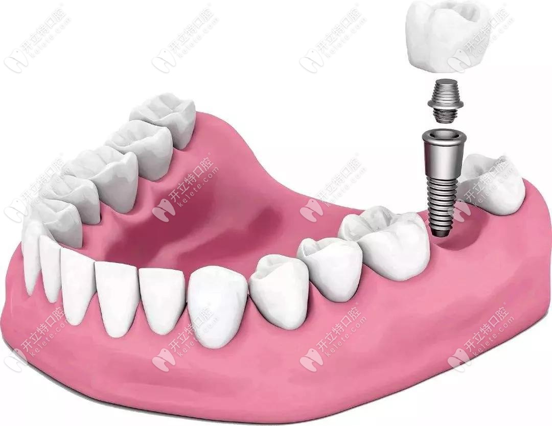 茁悦口腔的种植牙技术介绍
