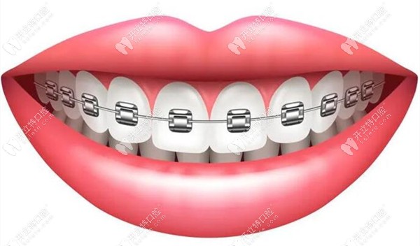 牙套的类型图片
