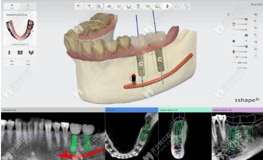 3D数字化种植牙方案设计