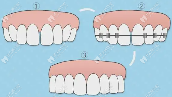 初戴托槽牙齿会有酸痛，粘膜易受损