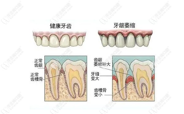 牙槽骨吸收的图片