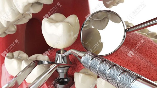 重庆牙博士口腔医院种植牙