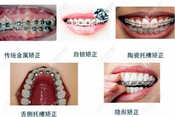 牙齿矫正的几种类型图