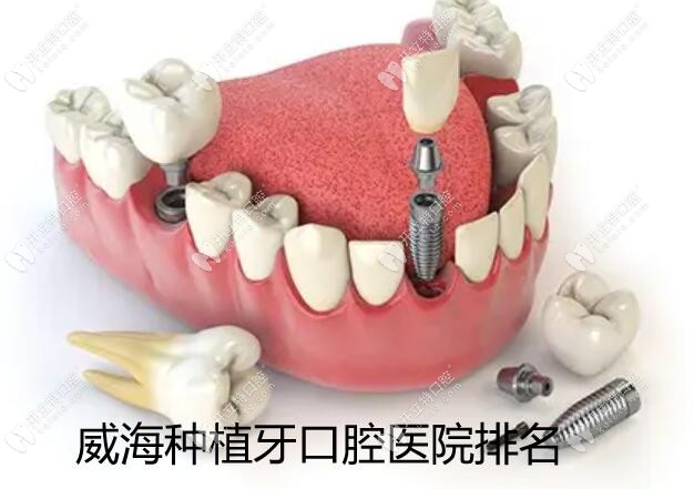 威海种植牙口腔医院排名