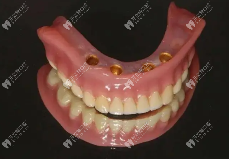种植覆盖义齿种类如下