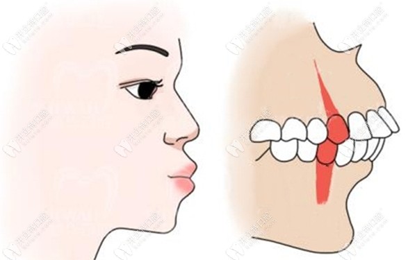 拔牙矫正是改善凸嘴的常用方法