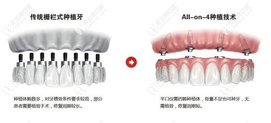 诺一齿科ALLON4种植牙技术