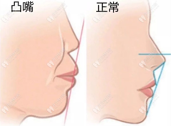 骨性凸嘴和正常面型对比