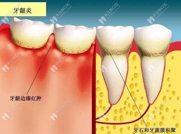 病理性牙龈萎缩的治疗方法