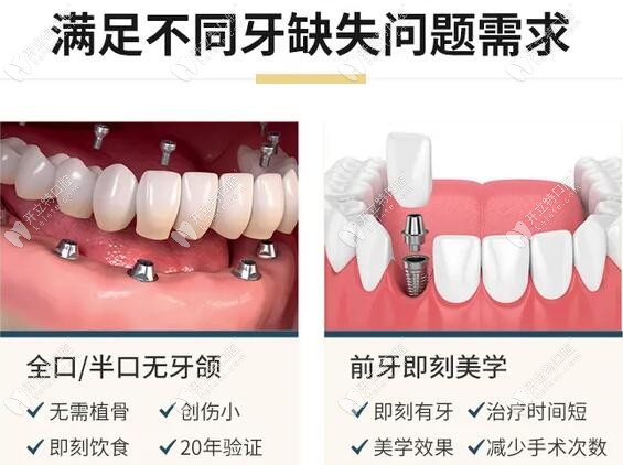 深圳千喜口腔肖锋医生种植牙技术怎么样