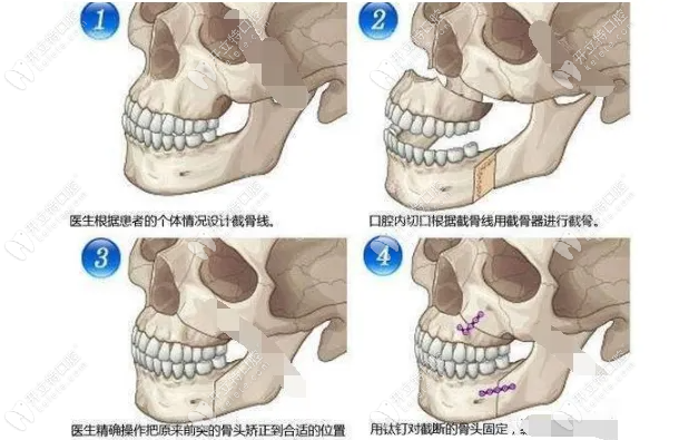 骨性凸嘴需要采用正畸正颌联合手术来改善