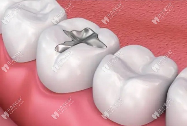 虫牙初期（也就是浅龋时）建议补牙