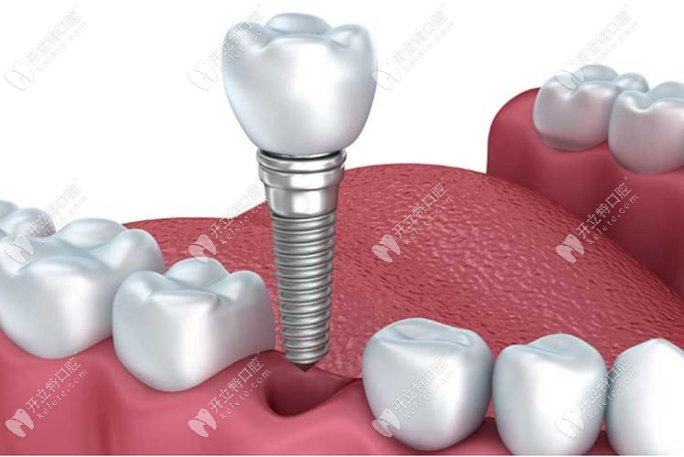 种植牙结构示意图