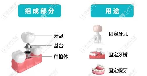 种植牙结构图