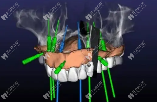 半口种植牙病例