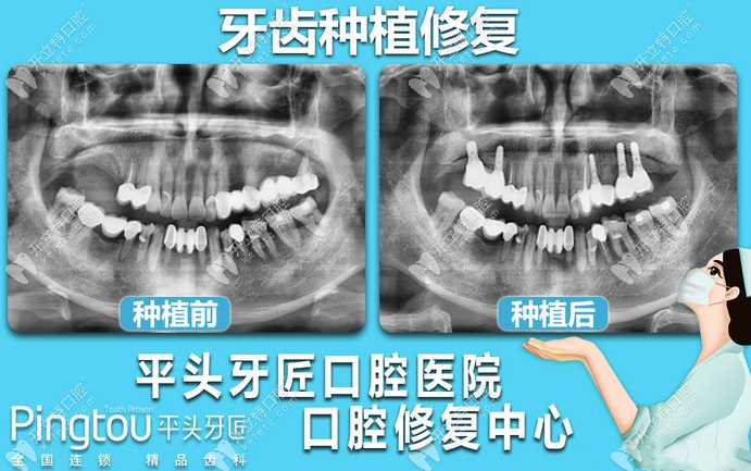 平头牙匠口腔种植病例