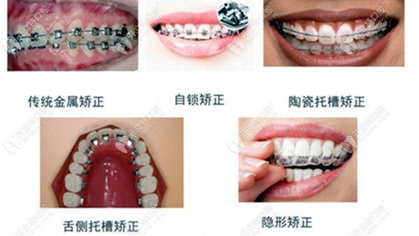 牙齿矫正的类型图片