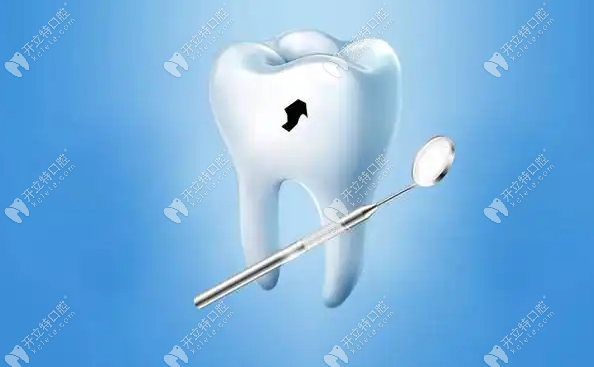龋齿的治疗方式www.kelete.com