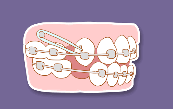 虎牙可以通过牙齿矫正进行改善