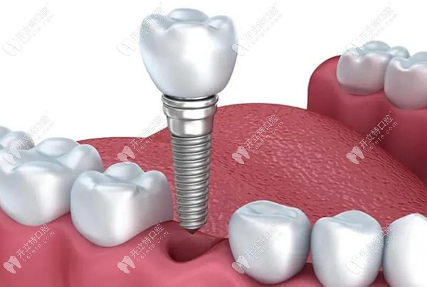 缺牙后进行种植牙修复