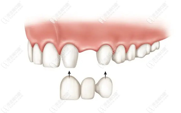 固定假牙的修复方式