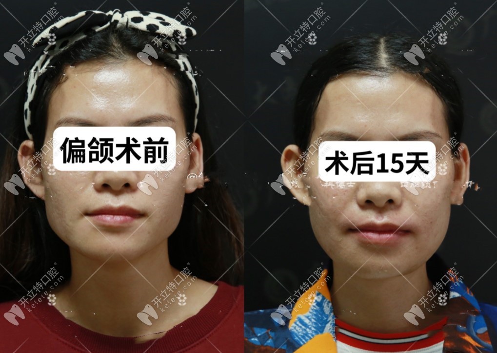 偏颌做正颌手术后脸型改变图对比