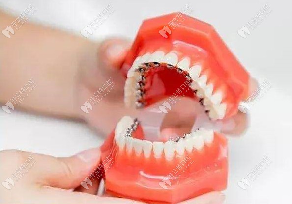 漳州冠成口腔可做舌侧隐形牙齿矫正