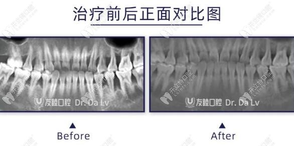 深圳友睦齿科吕达博士的牙周治疗病例