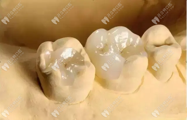 树脂补牙的图示
