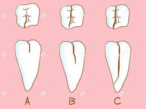牙隐裂是什么