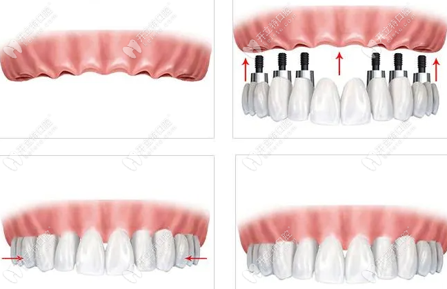 allon4全口即刻种植牙价格