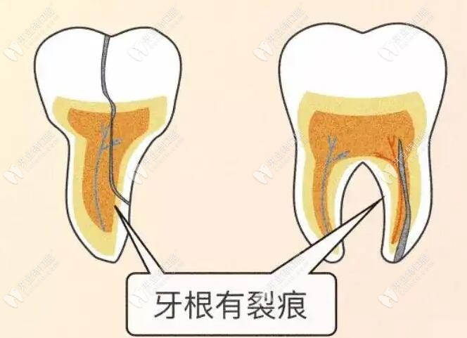 牙隐裂的主要症状