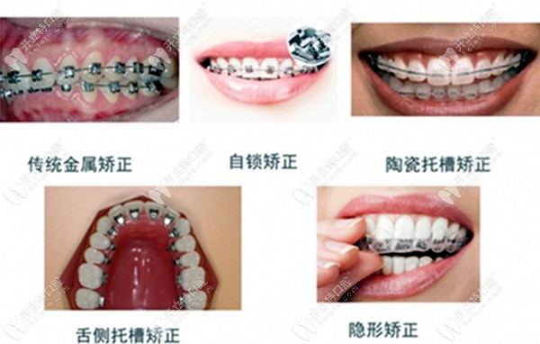 牙齿矫正的类型图片