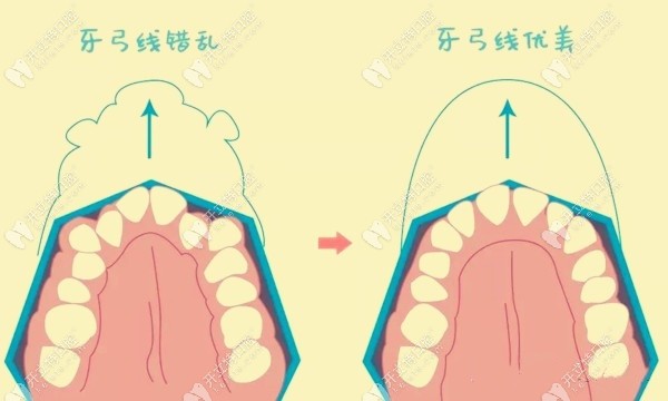 解答牙齿矫正为什么要扩弓？还有正畸扩弓的标准也要知道
