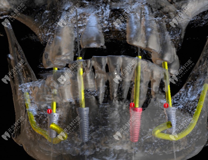 3D数字化种植牙技术