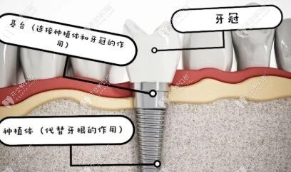 种植牙的组成结构图
