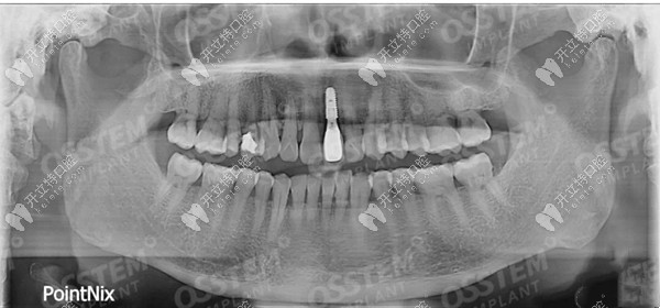宁波恩吉口腔单颗种植牙病例