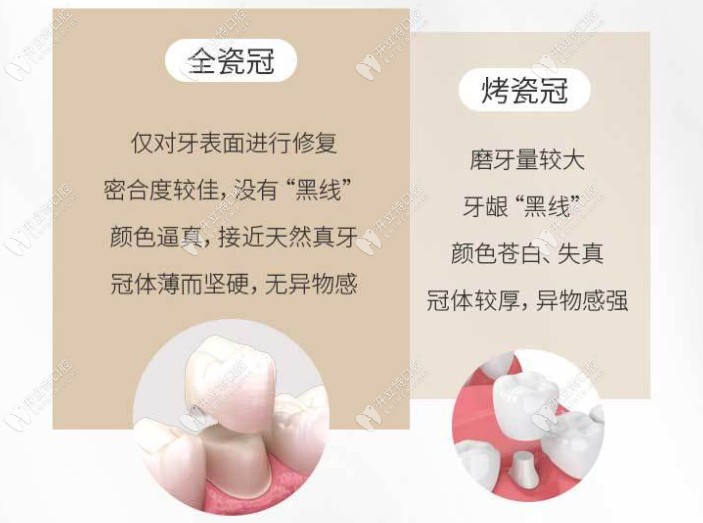 榆林雅美口腔全瓷牙和烤瓷牙優(yōu)缺點(diǎn)對(duì)比