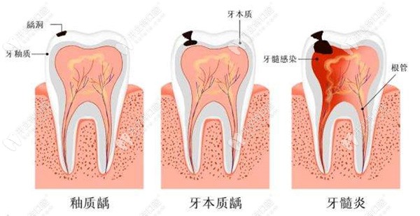 杭州上城胡佳口腔诊所牙体牙髓病