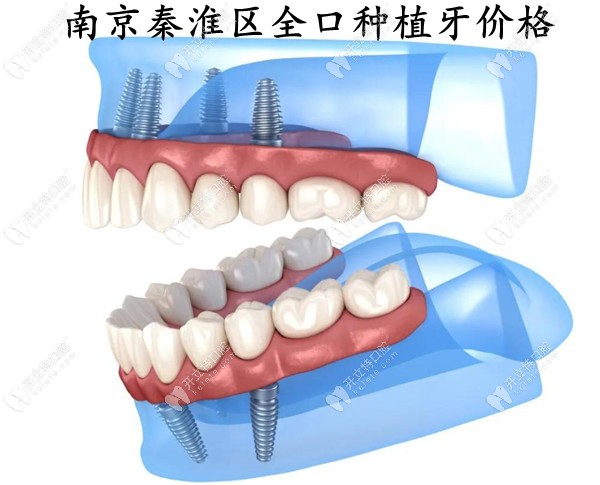 南京秦淮区全口种植牙的价格要多少钱