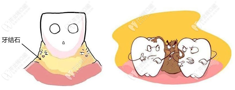牙结石、牙菌斑都会造成牙龈出血