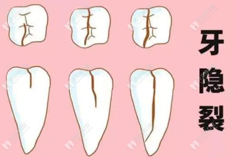 牙隐裂的不同程度