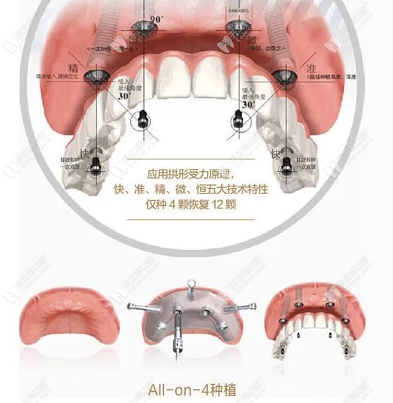 all-on-4半全口即刻负重种植牙技术